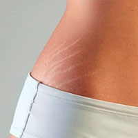 Estriort - Tratamento de estrias